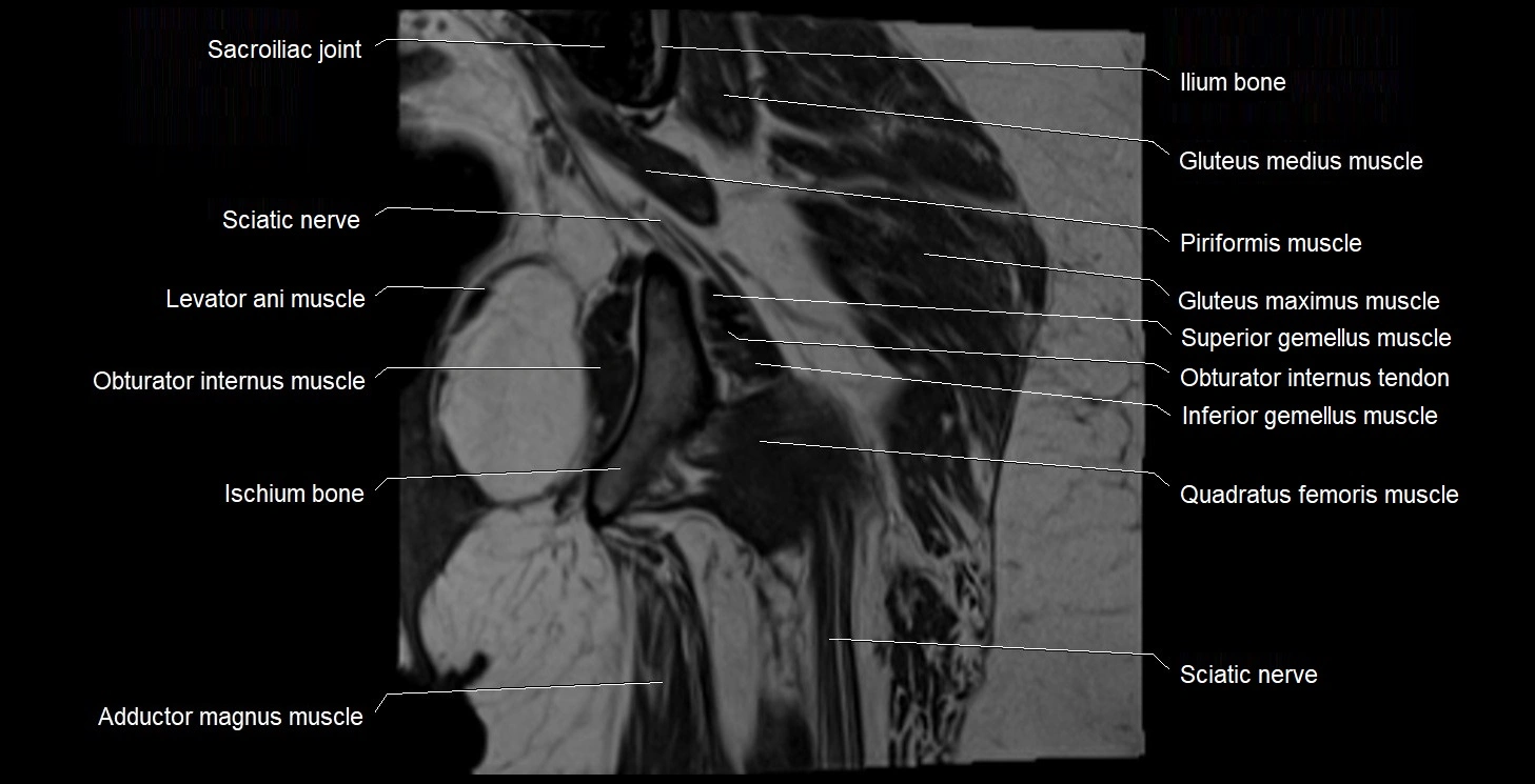 MRI Hip 3T coronal cross sectional anatomy image 48.webp